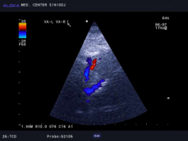 Ultrazvok možganskih žil - bazilarna in vertebralni arteriji normalen izvid 2